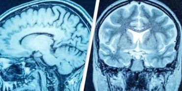 Beyninin-yarısı-yok-ama-hala-hayatta-