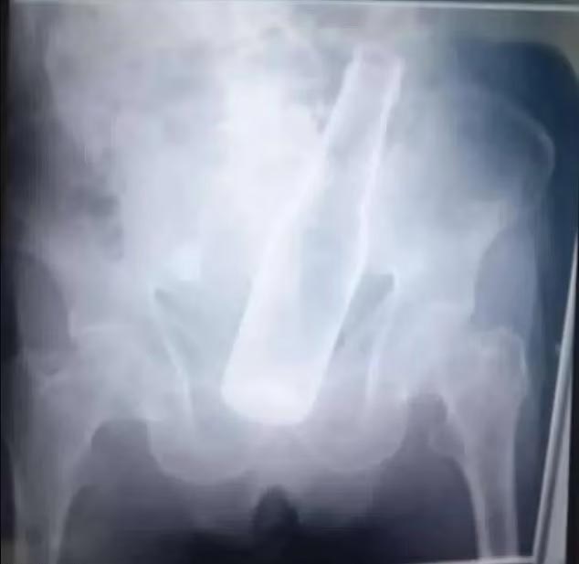 Makatında bira şişesiyle acil servise gelen hastadan ilginç savunma: Şişeyi hırsızlar soktu