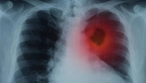 Akciğer embolisi nedir, neden olur? Akciğer embolisinin belirtileri nelerdir, tedavisi nasıl olur?