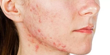 sivilce ve akneler neden olur