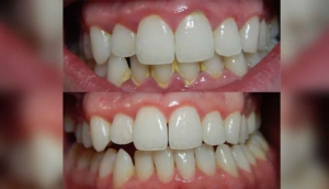 Bunları yaparak diş tartarından kurtulabilirsiniz! İşte diş taşlarını temizlemenin en etkili yolları