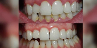 Bunları-yaparak-diş-tartarından-kurtulabilirsiniz!-İşte-diş-taşlarını-temizlemenin-en-etkili-yolları