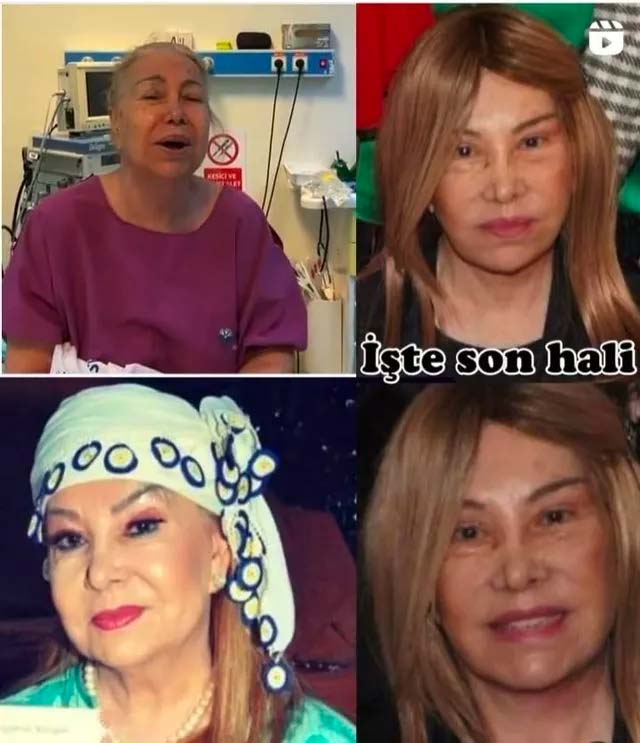 "Daha genç, daha güzel görünmek istiyorum" diyen 81 yaşındaki Bedia Akartürk yüzünü gerdirdi! İşte son hali