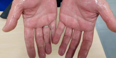 'İşaret-parmağı-uzun-olanlarda-kalp-krizi-yüksek-olabilir'-uyarısı-