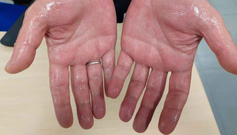 'İşaret parmağı uzun olanlarda kalp krizi yüksek olabilir' uyarısı