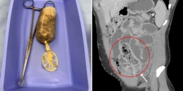 Karın-ağrısı-şikayetiyle-acile-başvurdu--Midesinden-prezervatife-doldurulmuş-muz-çıktı