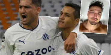 Milli-yıldız-Cengiz-Ünder-yüzüne-darbe-aldı!-“Seni-öldürmeyen-şey-güçlendirir”