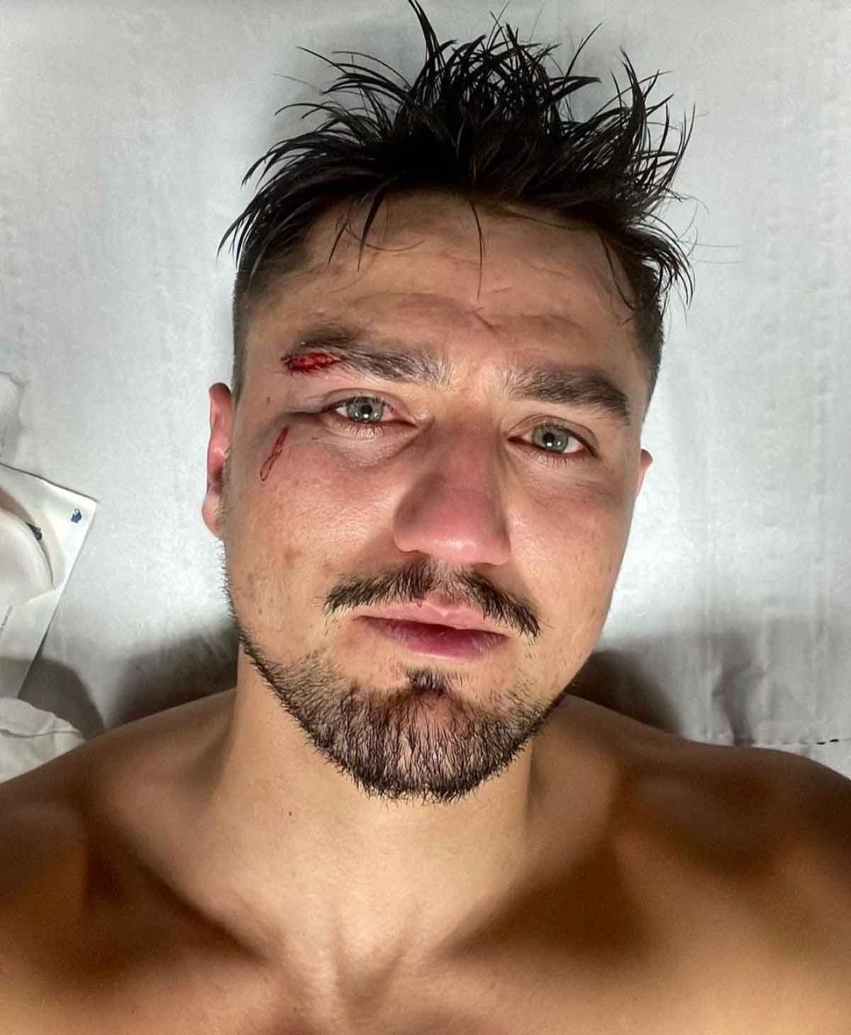 Milli yıldız Cengiz Ünder yüzüne darbe aldı! “Seni öldürmeyen şey güçlendirir”