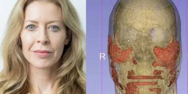 Tıp-dünyasını-şoke-eden-olay--Botoksun-verdiği-hasar-ortaya-çıktı,-20-yıllık-kimyasal-yüzünden-çıktı