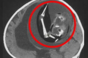 Doktora götürülen bir yaşındaki bebeğin beyninden doğmamış ikizi çıkarıldı 10 Doktora-götürülen-bir-yaşındaki-bebeğin-beyninden-doğmamış-ikizi-çıkarıldı