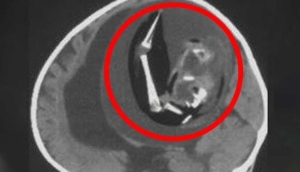 Doktora-götürülen-bir-yaşındaki-bebeğin-beyninden-doğmamış-ikizi-çıkarıldı