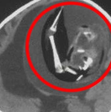 Doktora götürülen bir yaşındaki bebeğin beyninden doğmamış ikizi çıkarıldı 7 Doktora-götürülen-bir-yaşındaki-bebeğin-beyninden-doğmamış-ikizi-çıkarıldı