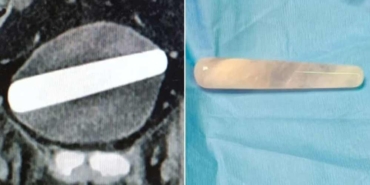 Vajina-yerine-üretrasına-soktuğu-seks-oyuncağı-ameliyatla-alındı!