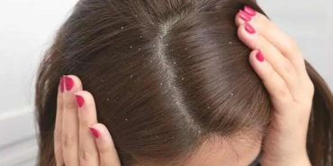 Kepekli-saçlardan-kurtulmanın-yolları!-Bu-doğal-yöntem-sayesinde-kepek-kalmıyor
