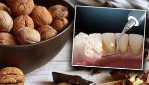 Ceviz kabuğu mucizesi! Diş tartarı nasıl temizlenir? Evde uygulanabilecek doğal yöntemler