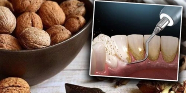 Ceviz-kabuğu-mucizesi!-Diş-tartarı-nasıl-temizlenir--Evde-uygulanabilecek-doğal-yöntemler