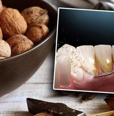 Ceviz kabuğu mucizesi! Diş tartarı nasıl temizlenir? Evde uygulanabilecek doğal yöntemler 4 Ceviz-kabuğu-mucizesi!-Diş-tartarı-nasıl-temizlenir--Evde-uygulanabilecek-doğal-yöntemler