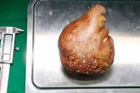 Dünyanın en büyük böbrek taşı çıkarıldı: Portakal boyunda, 801 gram ağırlığında! 3 Dünyanın-en-büyük-böbrek-taşı-çıkarıldı--Portakal-boyunda,-801-gram-ağırlığında!