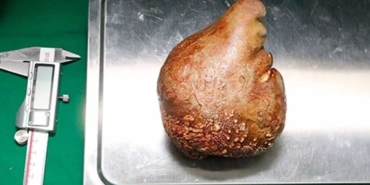 Dünyanın-en-büyük-böbrek-taşı-çıkarıldı--Portakal-boyunda,-801-gram-ağırlığında!