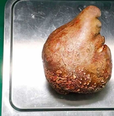 Dünyanın-en-büyük-böbrek-taşı-çıkarıldı--Portakal-boyunda,-801-gram-ağırlığında!