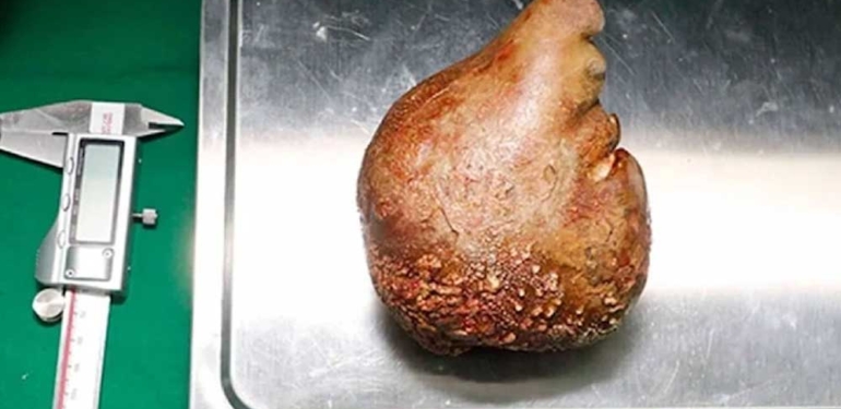 Dünyanın en büyük böbrek taşı çıkarıldı: Portakal boyunda, 801 gram ağırlığında! 6 Dünyanın-en-büyük-böbrek-taşı-çıkarıldı--Portakal-boyunda,-801-gram-ağırlığında!