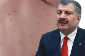 Kızamık vakalarındaki artışla ilgili Bakan Koca’dan endişe veren açıklama: Yüzde 86’sı İstanbul’da 1 Kızamık-vakalarındaki-artışla-ilgili-Bakan-Koca’dan-endişe-veren-açıklama--Yüzde-86’sı-İstanbul’da