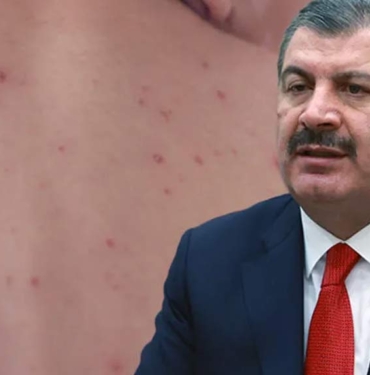 Kızamık vakalarındaki artışla ilgili Bakan Koca’dan endişe veren açıklama: Yüzde 86’sı İstanbul’da 8 Kızamık-vakalarındaki-artışla-ilgili-Bakan-Koca’dan-endişe-veren-açıklama--Yüzde-86’sı-İstanbul’da