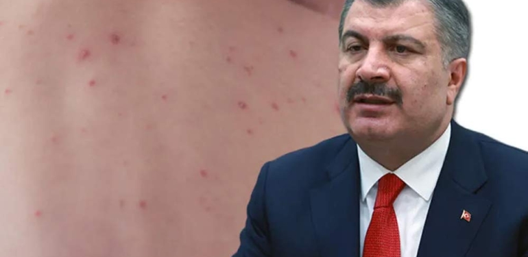Kızamık vakalarındaki artışla ilgili Bakan Koca’dan endişe veren açıklama: Yüzde 86’sı İstanbul’da 1 Kızamık-vakalarındaki-artışla-ilgili-Bakan-Koca’dan-endişe-veren-açıklama--Yüzde-86’sı-İstanbul’da