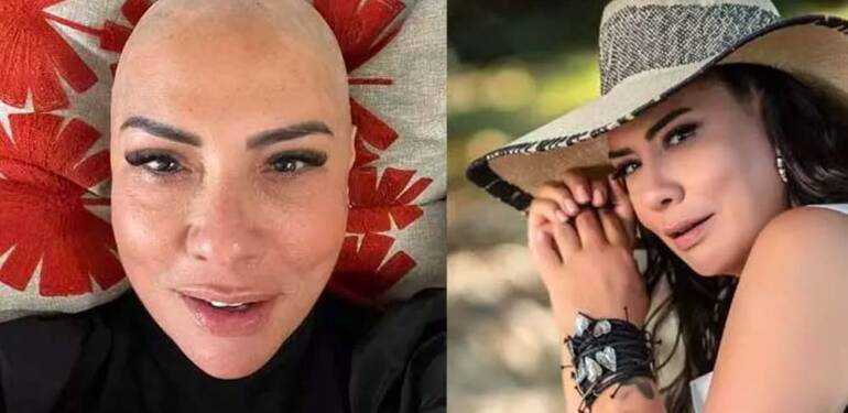 Işın Karaca’nın saç kıran hastalığında ‘Covid’ iddiası