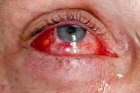 Bulaşıcı ‘kırmızı göz’ hastalığı hızla yayılıyor: Sayı 86 bini geçti 6 Bulaşıcı-‘kırmızı-göz’-hastalığı-hızla-yayılıyor--Sayı-86-bini-geçti