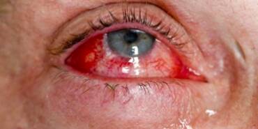 Bulaşıcı-‘kırmızı-göz’-hastalığı-hızla-yayılıyor--Sayı-86-bini-geçti