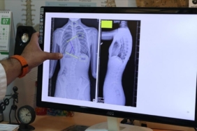 Çocuklarda ergenlik öncesi skolyoz kontrolü tedavi şansını artırıyor! 3 Çocuklarda ergenlik öncesi skolyoz kontrolü tedavi şansını artırıyor!