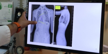 Çocuklarda ergenlik öncesi skolyoz kontrolü tedavi şansını artırıyor!