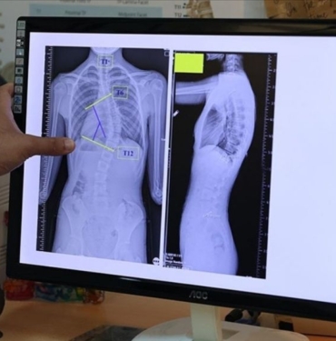 Çocuklarda ergenlik öncesi skolyoz kontrolü tedavi şansını artırıyor! 3 Çocuklarda ergenlik öncesi skolyoz kontrolü tedavi şansını artırıyor!