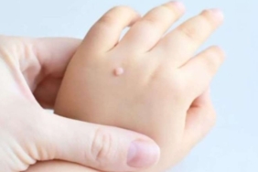 Oluşum nedenleri ve tedavi yöntemleri: Siğiller hakkında her şey 10 siğil