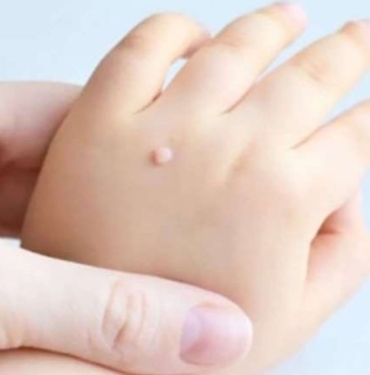 Oluşum nedenleri ve tedavi yöntemleri: Siğiller hakkında her şey 3 siğil