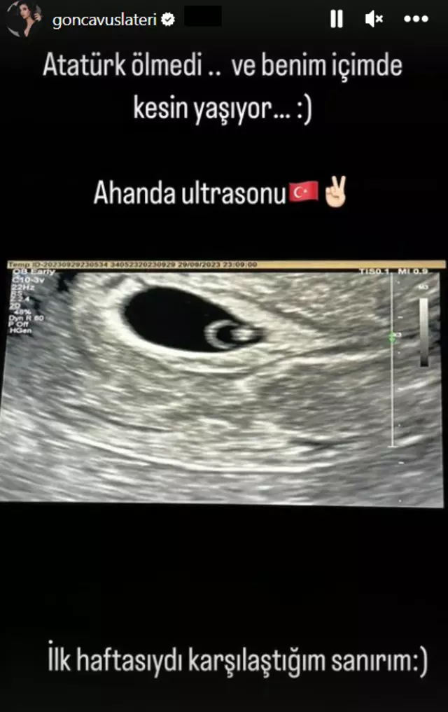 Gonca Vuslateri ultrason görüntüsünü yayımladı! O detay dikkat çekti