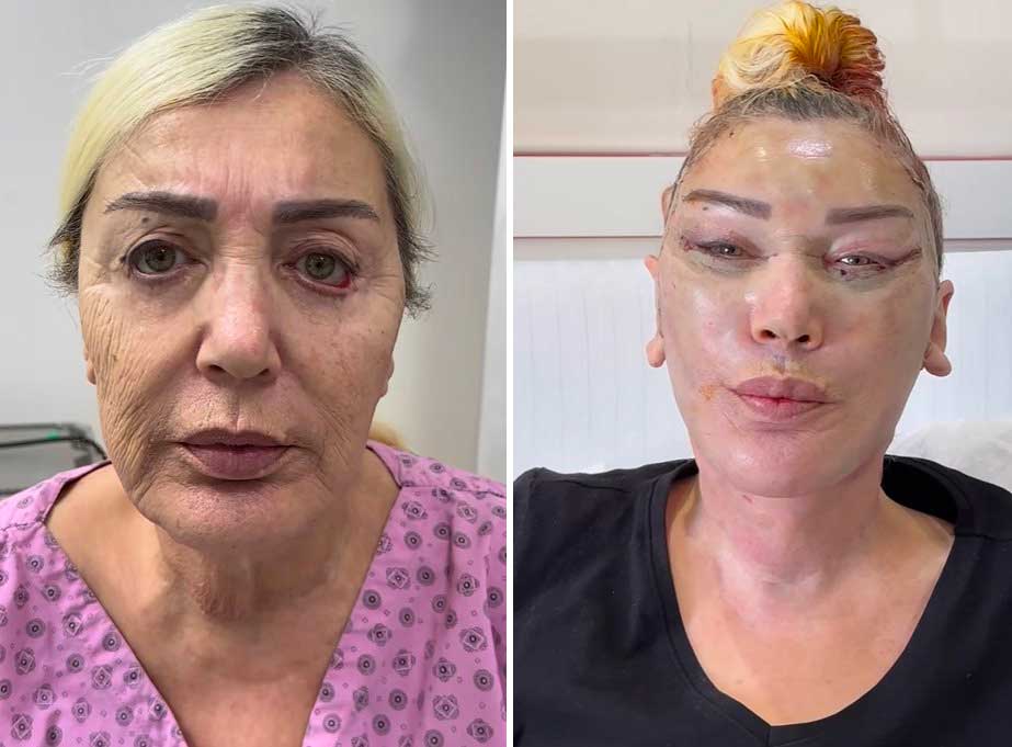 Seda Sayan’ın ablası da gençleşmek için bıçak altına yattı... Görenler tanıyamadı! 3 Seda Sayan’ın ablası da gençleşmek için bıçak altına yattı... Görenler tanıyamadı!