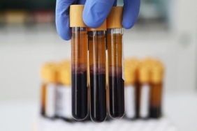 Kan testiyle hızlı ve yavaş yaşlanan organlar tespit edilebilir 1 Kan testiyle hızlı ve yavaş yaşlanan organlar tespit edilebilir