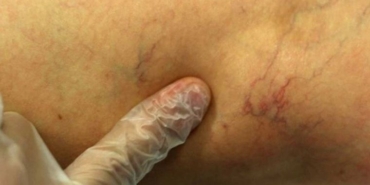 Önemsenmeyen bacak varisleri kalıcı hasarlara neden olabiliyor