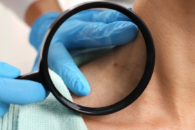 Sıradan bir ben: Hızla artan 'siyah tümör' melanom nasıl anlaşılır? 3 Siradan-bir-ben-Hizla-artan-8216siyah-tumor8217-melanom-nasil-anlasilir-featured