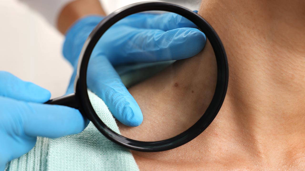 Sıradan bir ben: Hızla artan 'siyah tümör' melanom nasıl anlaşılır? 4 Siradan-bir-ben-Hizla-artan-8216siyah-tumor8217-melanom-nasil-anlasilir-featured